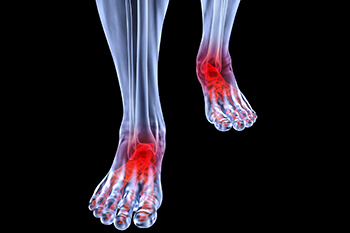 Arthritic foot and ankle care treatment in the Los Angeles County, CA: Los Angeles, Beverly Hills, Culver City, Santa Monica, Marina Del Rey, Inglewood, Thousand Oaks, Burbank, Glendale, Pasadena, Malibu areas