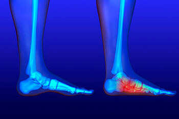 Flat feet and Fallen Arches treatment in the Los Angeles County, CA: Los Angeles, Beverly Hills, Culver City, Santa Monica, Marina Del Rey, Inglewood, Thousand Oaks, Burbank, Glendale, Pasadena, Malibu areas