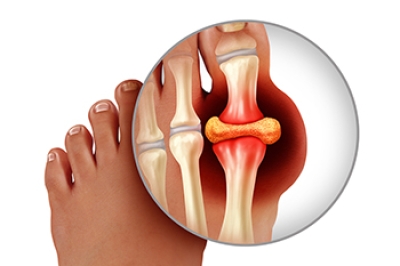 Facts About Gout