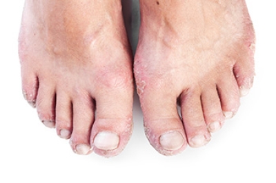 Managing Eczema on the Feet