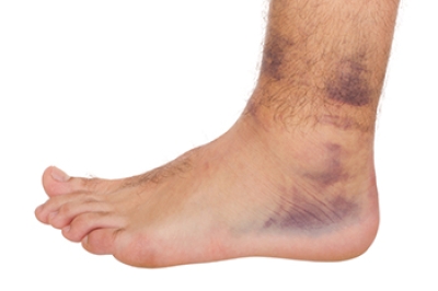 Types of Ankle Sprains