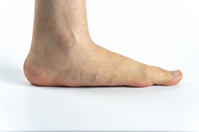 Causes and Relief From Flat Feet