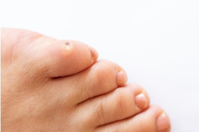 Why Foot Corns Are Painful